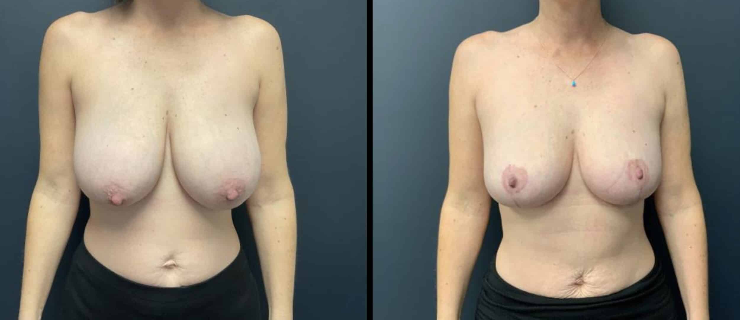 topless female patient before and after breast reduction surgery, breasts much smaller after procedure