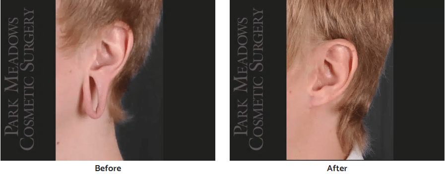 before and after earlobe repair Highlands Ranch CO