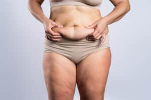 Tummy tuck, flabby skin on a fat belly, plastic surgery concept