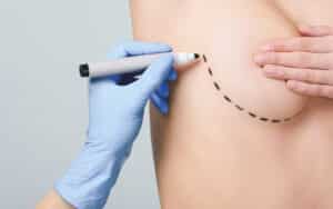 Direct To Implant Breast Reconstruction