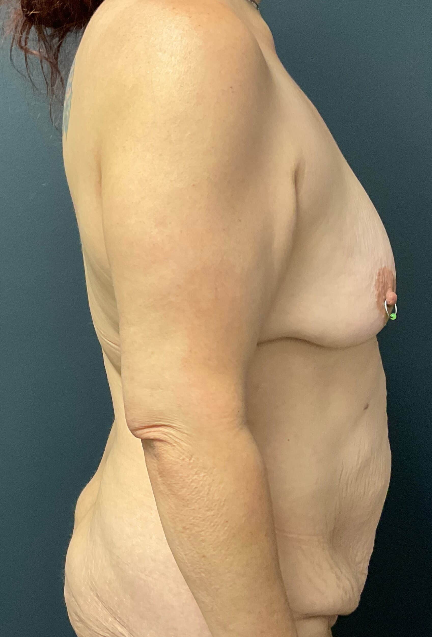 Before Image: Abdominoplasty; Breast Lift with Augmentation; 425cc Silicone Implants - right-side
