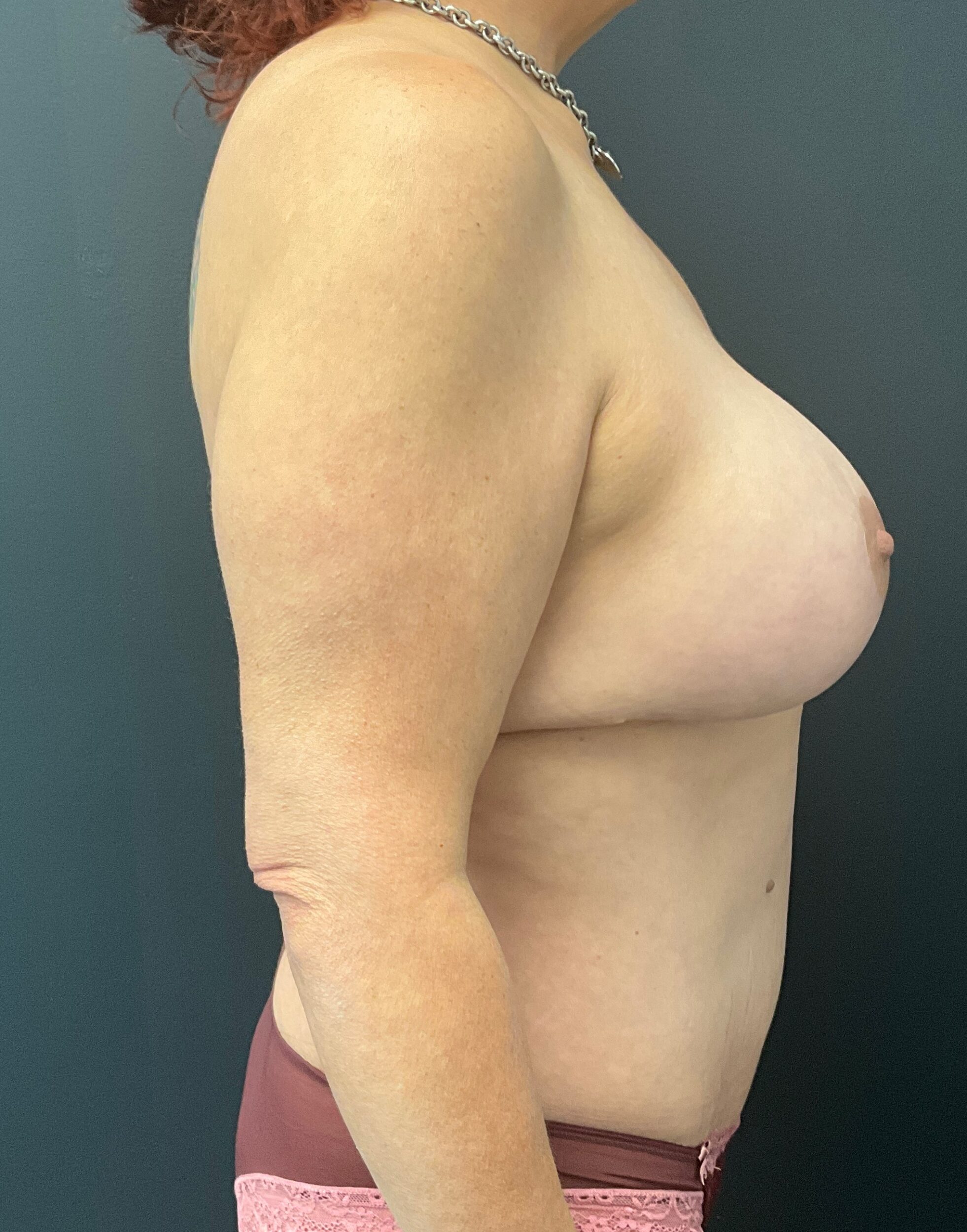 After Image: Abdominoplasty; Breast Lift with Augmentation; 425cc Silicone Implants - right-side