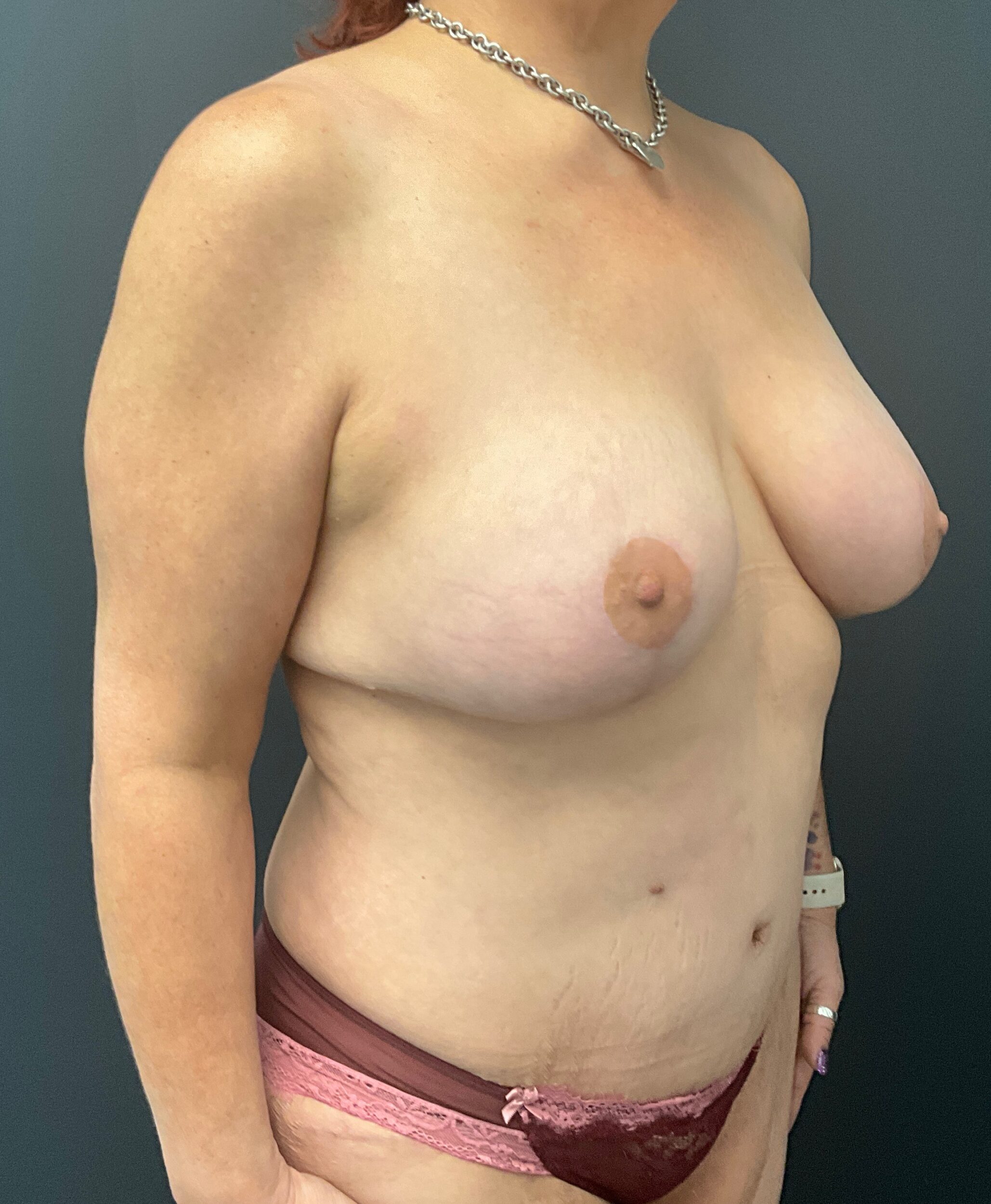 After Image: Abdominoplasty; Breast Lift with Augmentation; 425cc Silicone Implants - right-front-oblique