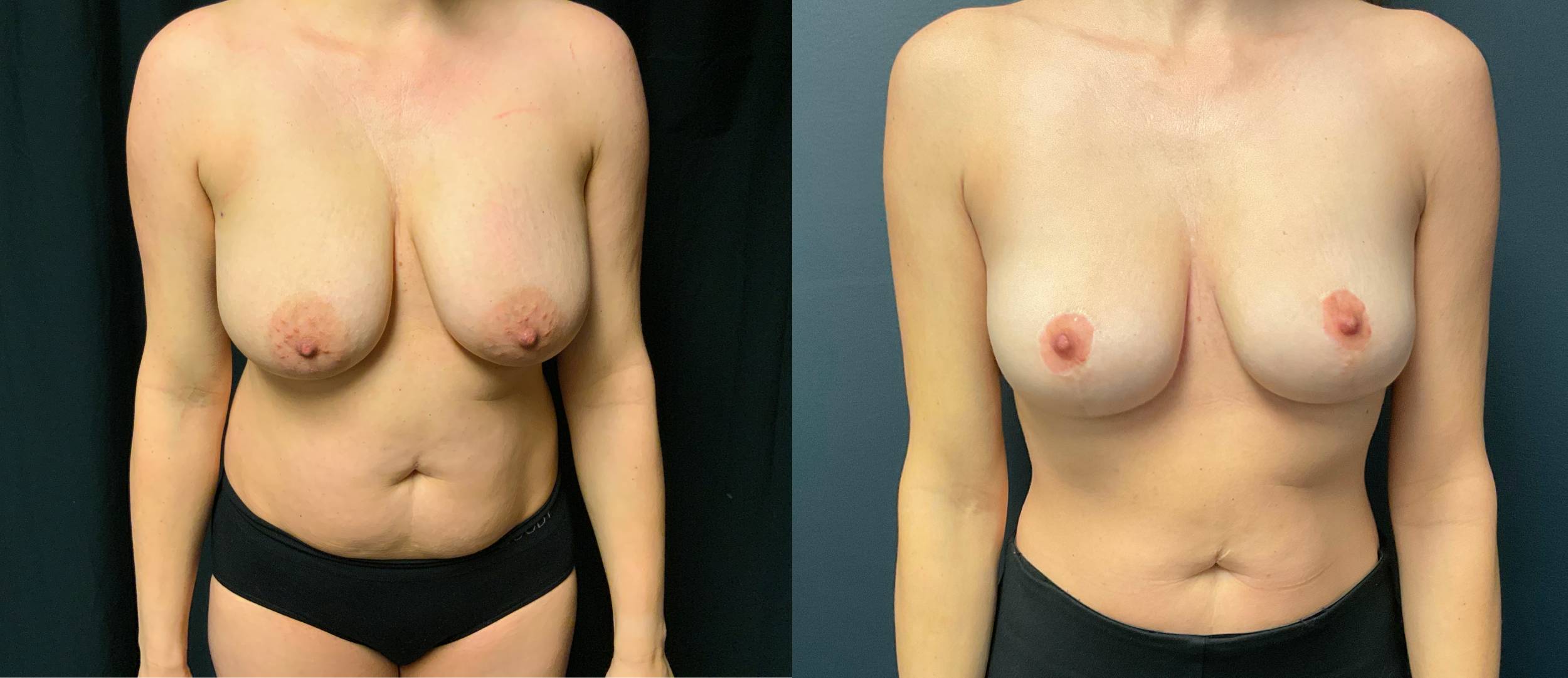 Breast Lift Surgery Highlands Ranch CO