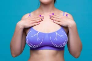 Breast,Augmentation,,Female,Body,With,Surgical,Lines,,Plastic,Surgery,And