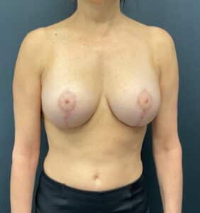 350cc Silicone Breast Implants with Mastopexy and Lipo of Axilla