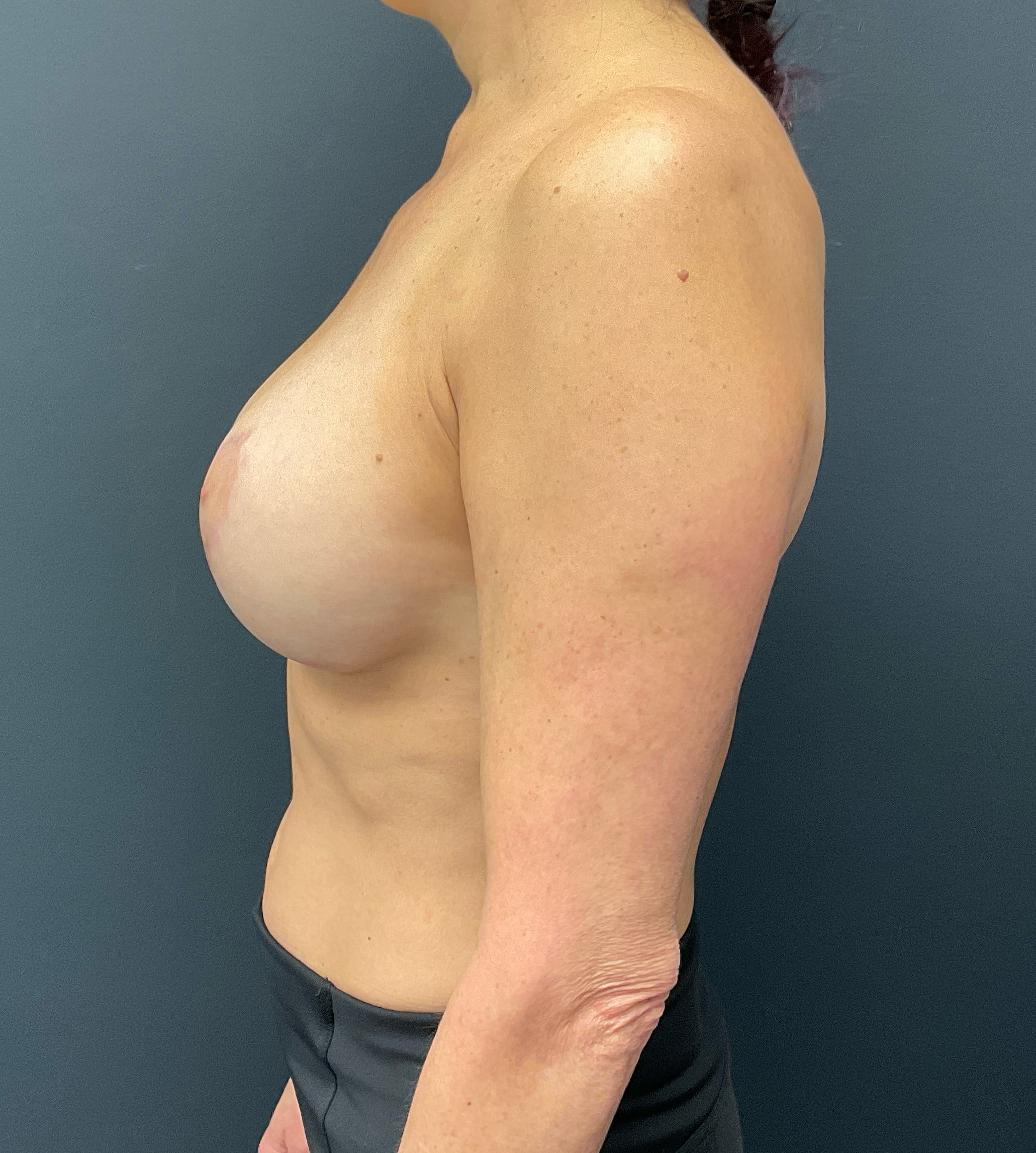 After Image: 350cc Silicone Breast Implants with Mastopexy and Lipo of Axilla - left-side