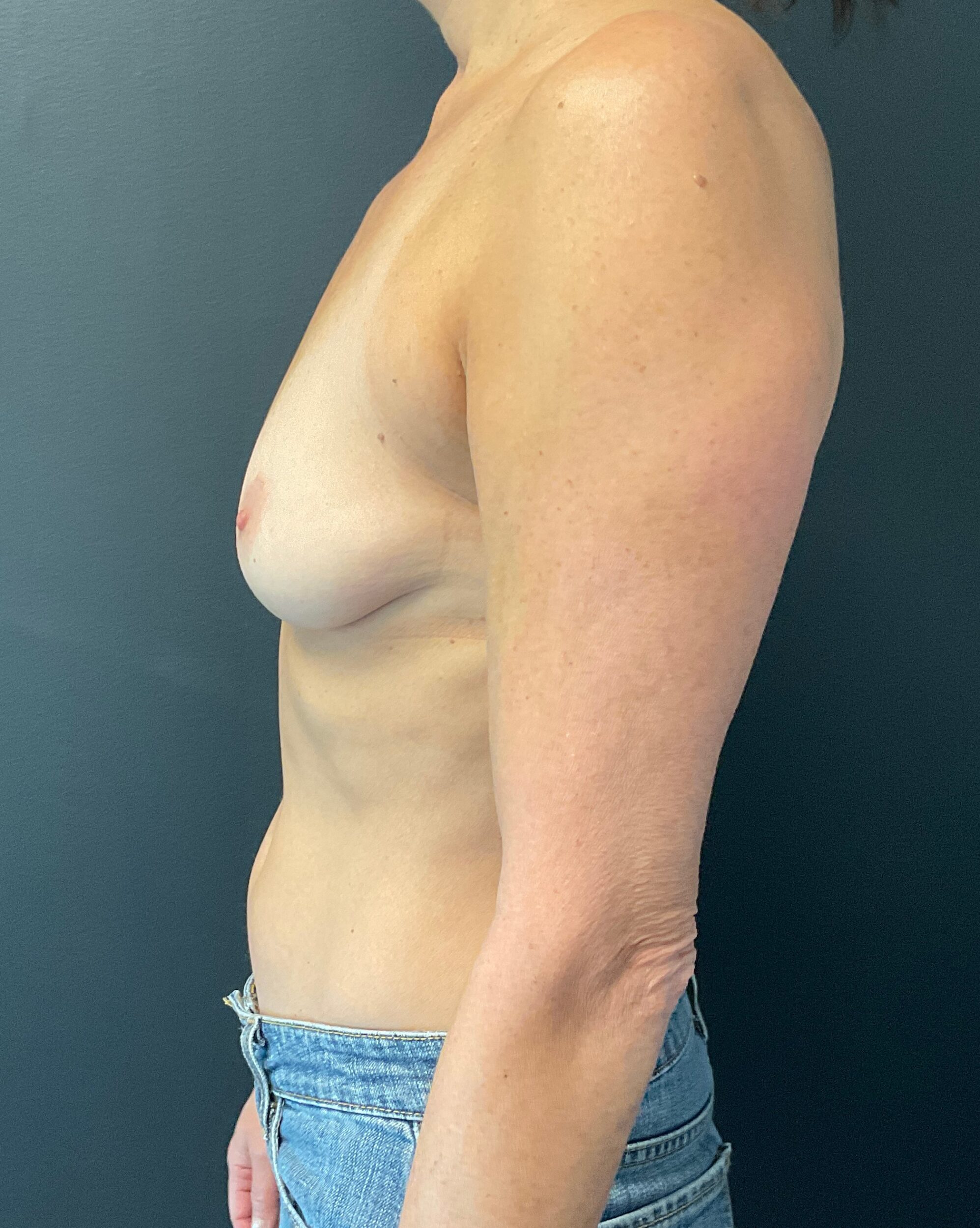 Before Image: 350cc Silicone Breast Implants with Mastopexy and Lipo of Axilla - left-side