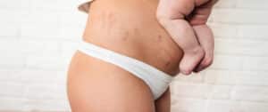 Woman with stretch marks holding her baby and considering a postpartum tummy tuck
