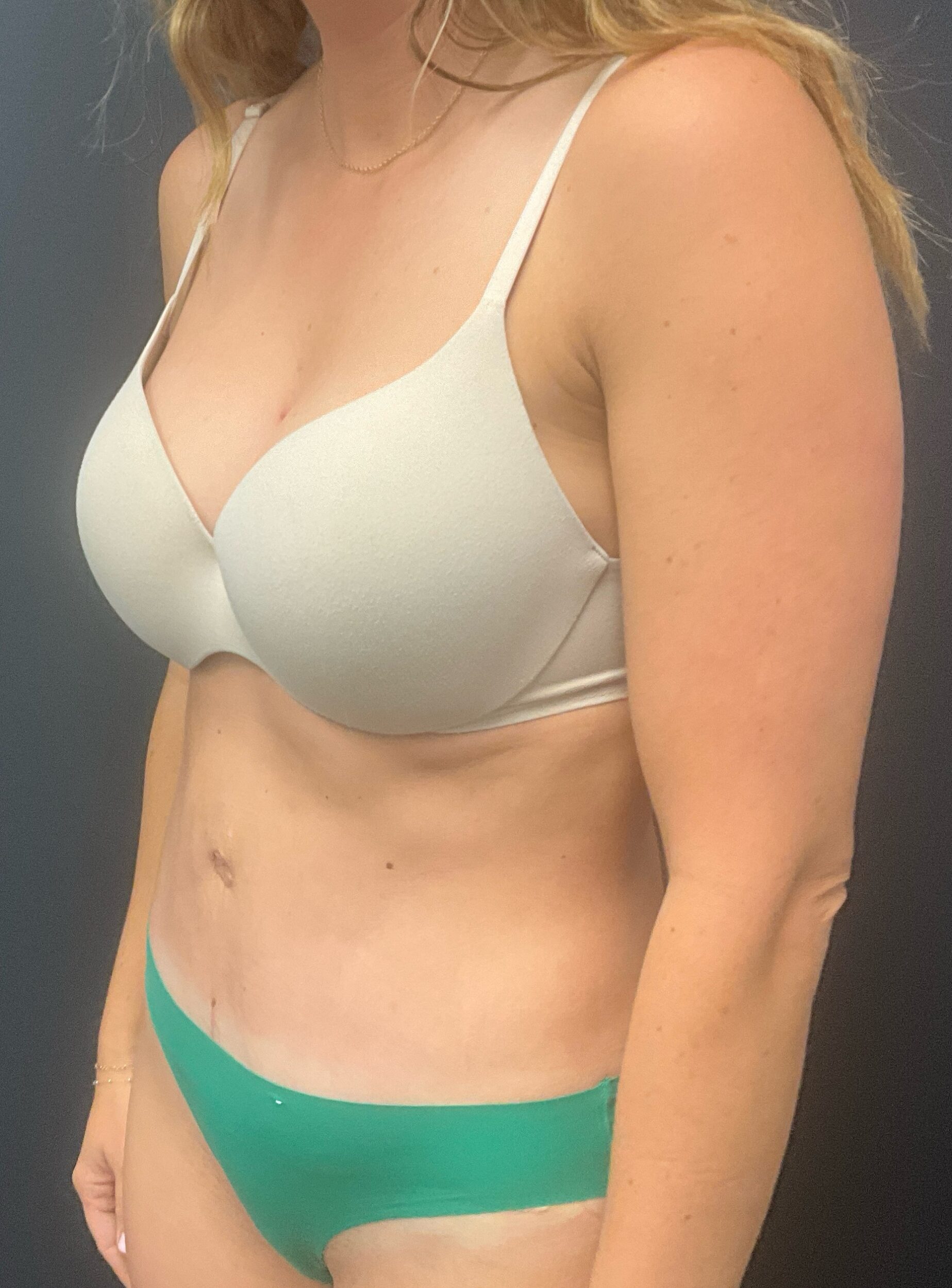 After Image: Abdominoplasty with Liposuction of Flanks - left-front-oblique