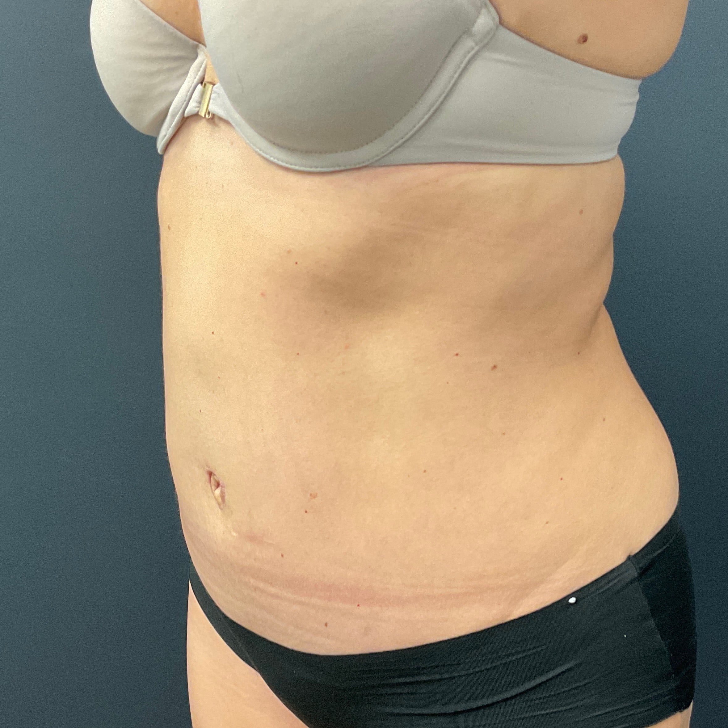 After Image: Abdominoplasty with Liposuction of Flanks - left-front-oblique