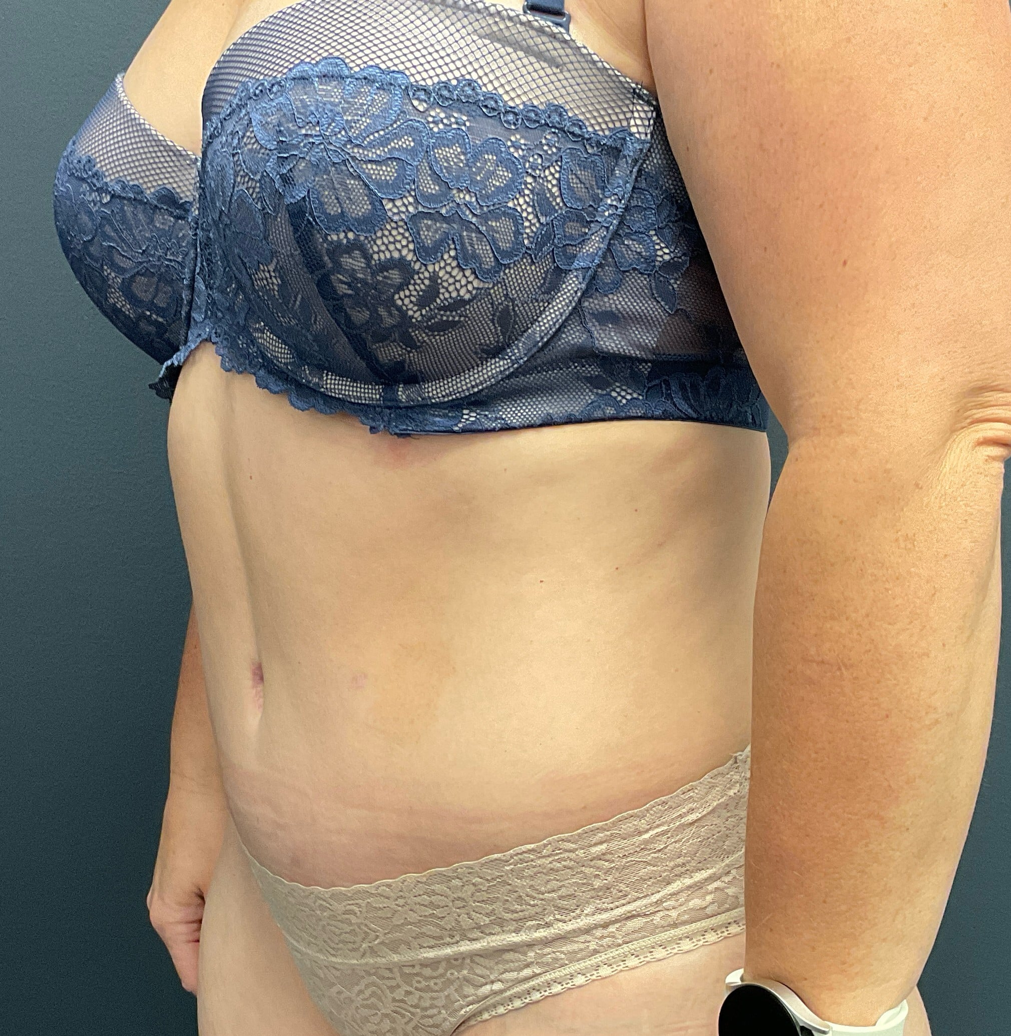 After Image: Abdominoplasty with Liposuction of Flanks - left-front-oblique
