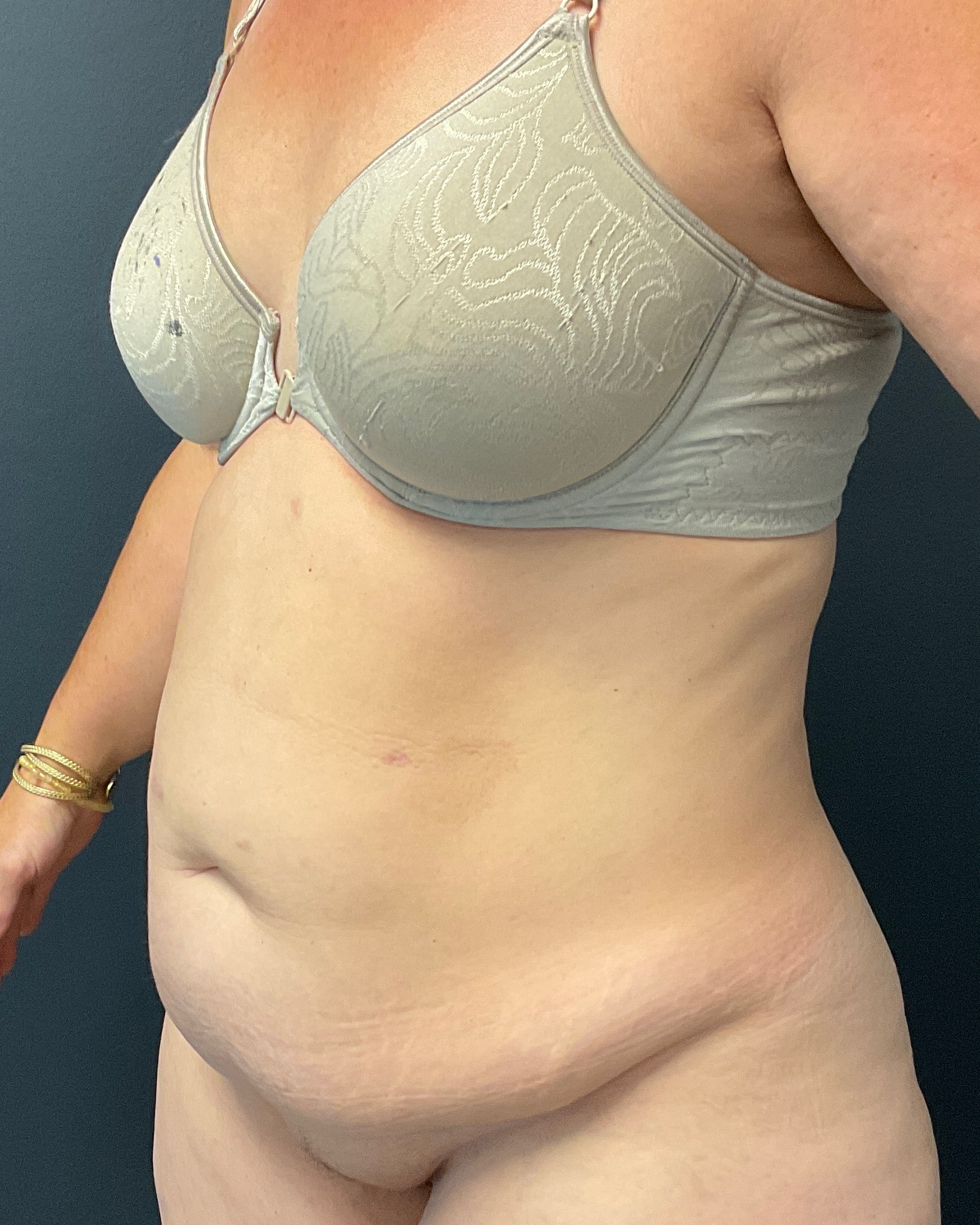 Before Image: Abdominoplasty with Liposuction of Flanks - left-front-oblique