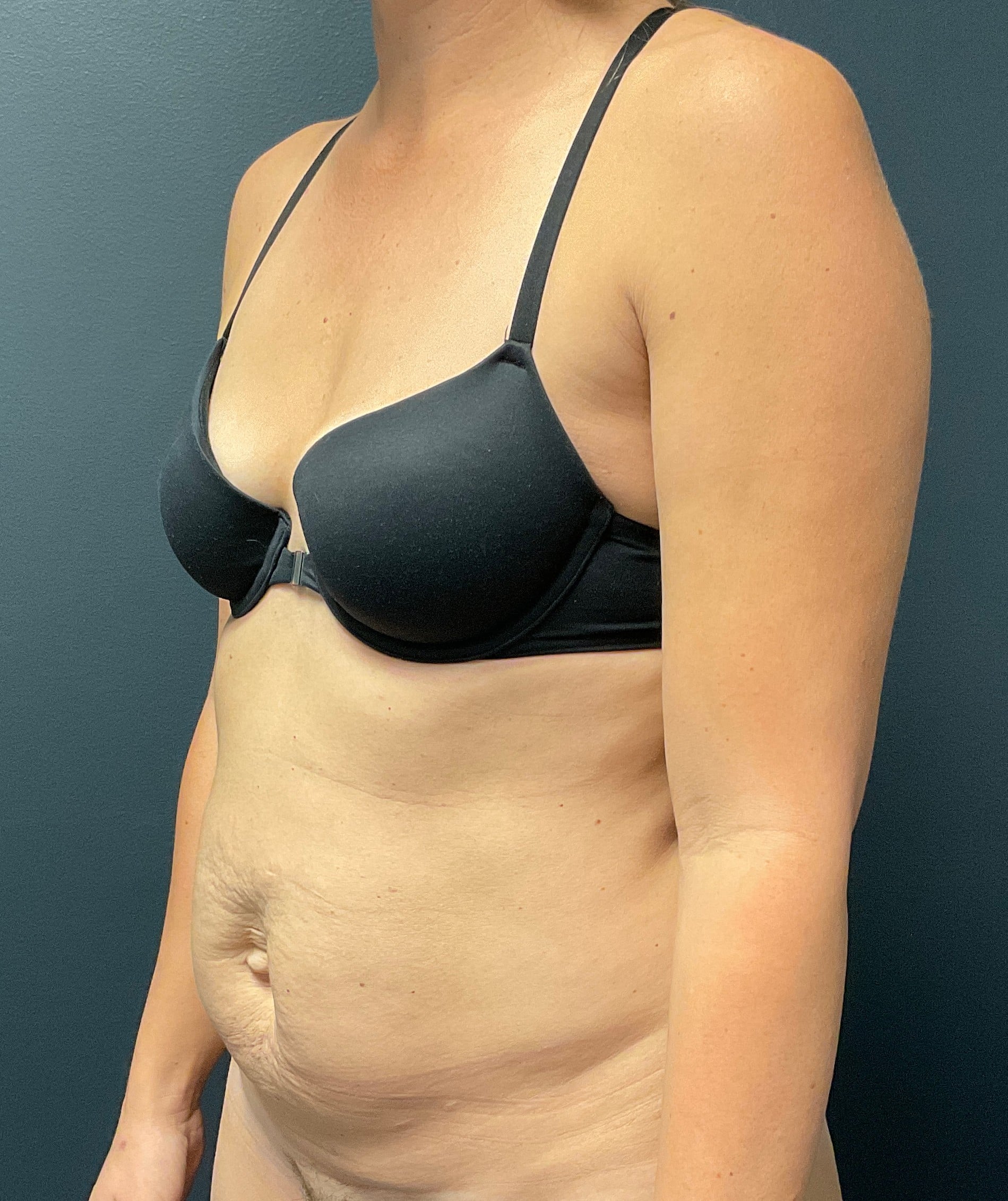 Before Image: Abdominoplasty with Liposuction of Flanks - left-front-oblique
