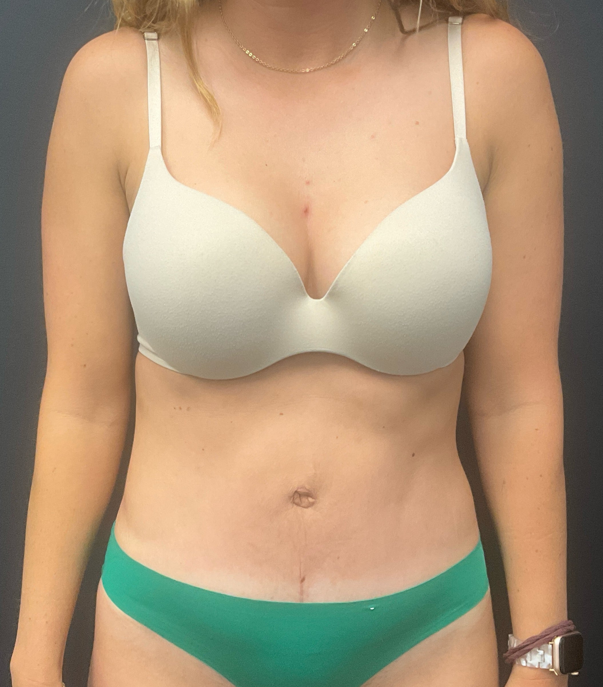 After Image: Abdominoplasty with Liposuction of Flanks - front