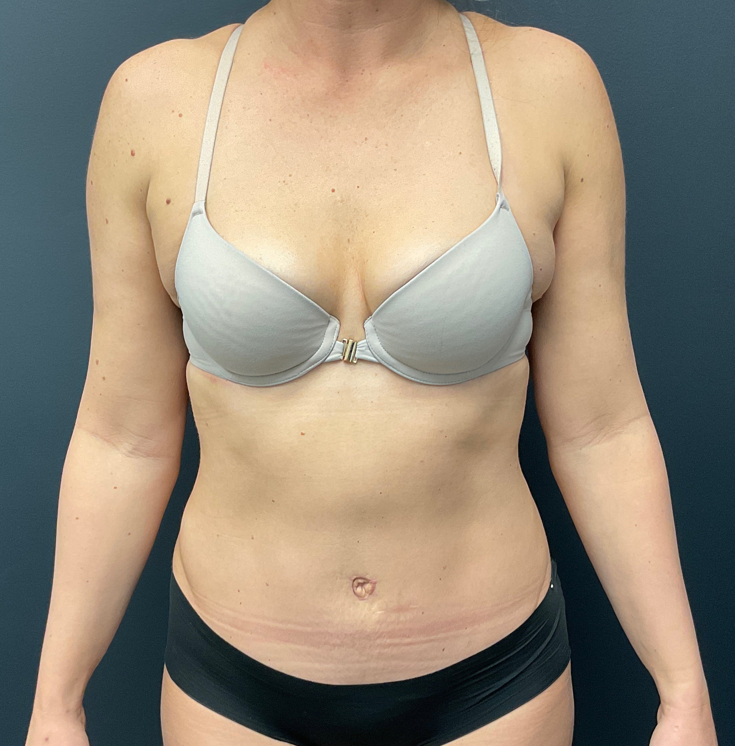 After Image: Abdominoplasty with Liposuction of Flanks - front