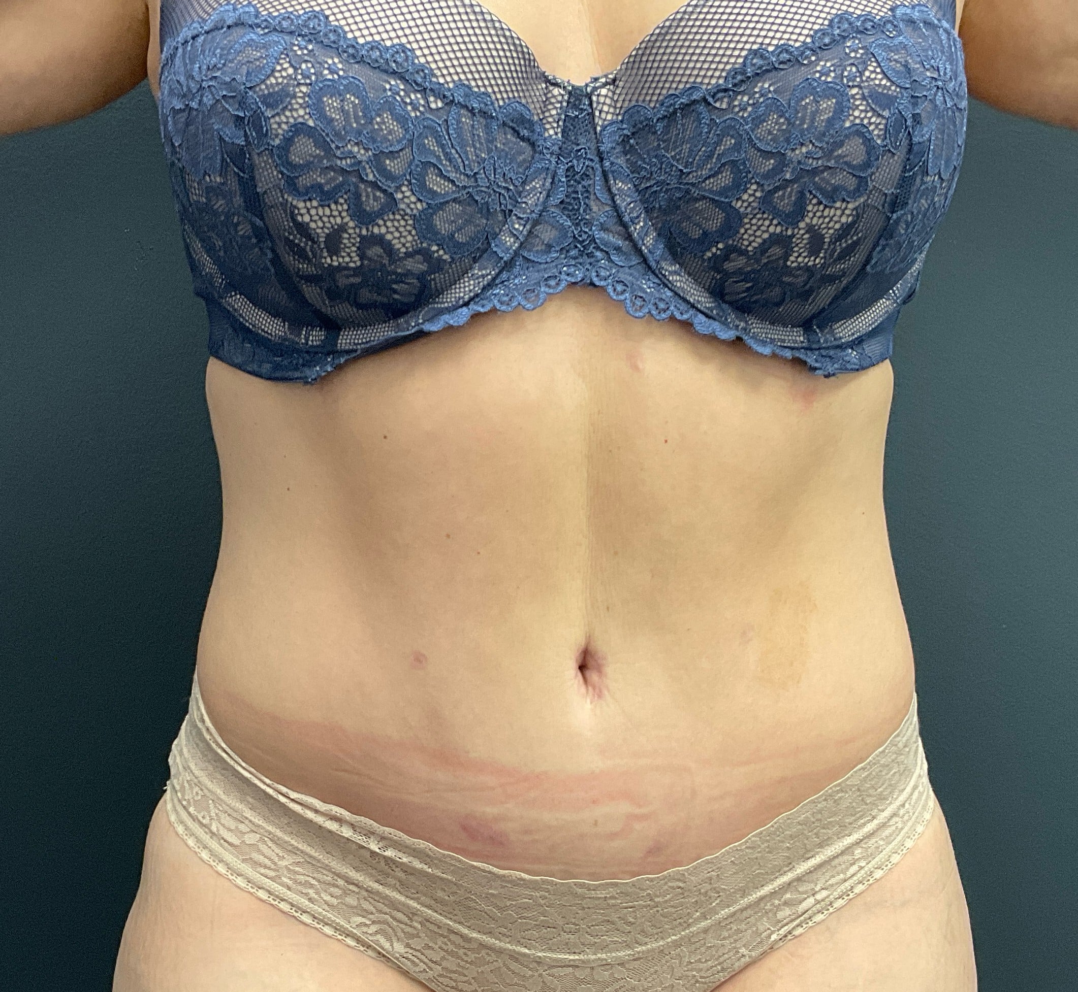 After Image: Abdominoplasty with Liposuction of Flanks - front