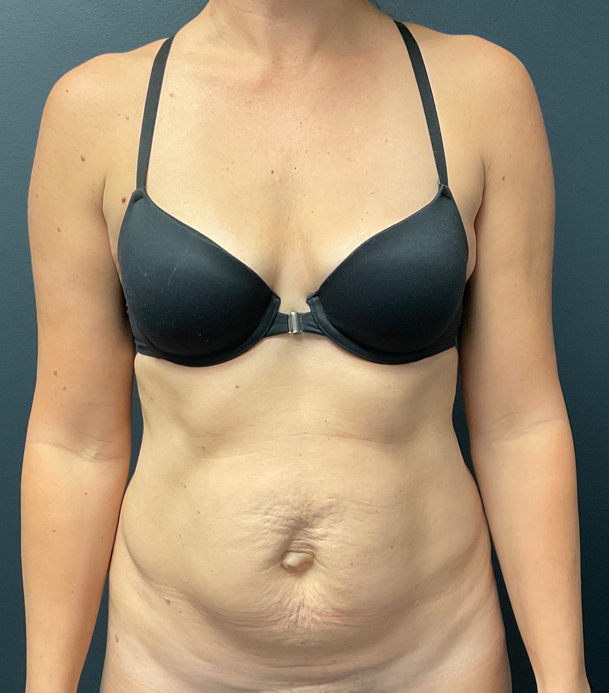 Before Image: Abdominoplasty with Liposuction of Flanks - front