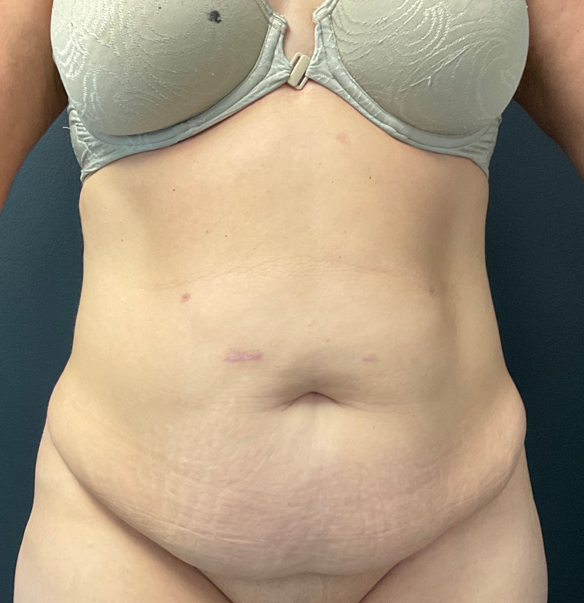 Before Image: Abdominoplasty with Liposuction of Flanks - front