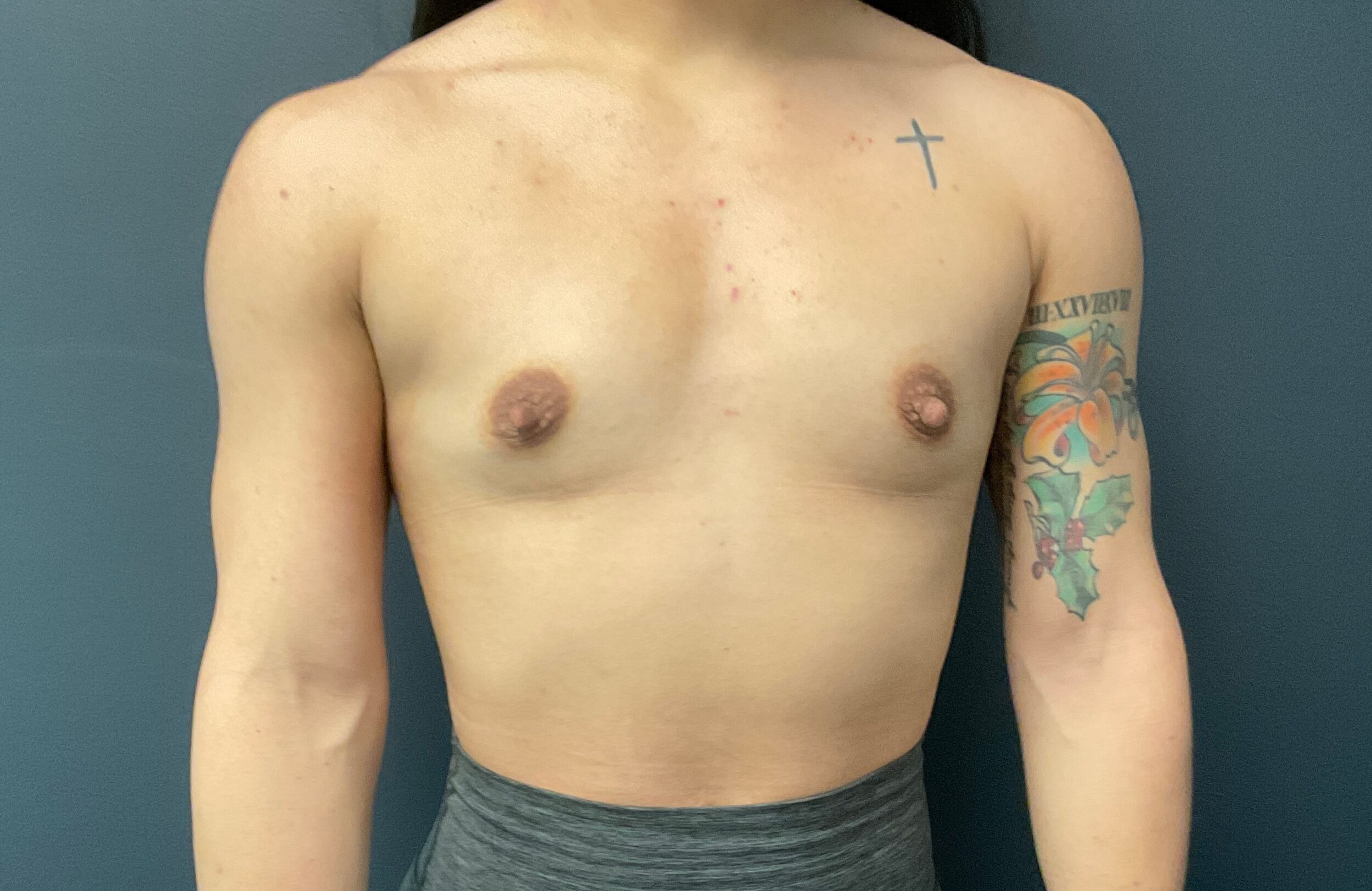 Before Image: Breast Augmentation: Mentor Smooth Round Moderate Plus Silicone Implants (L) 405cc, (R) 440cc - front