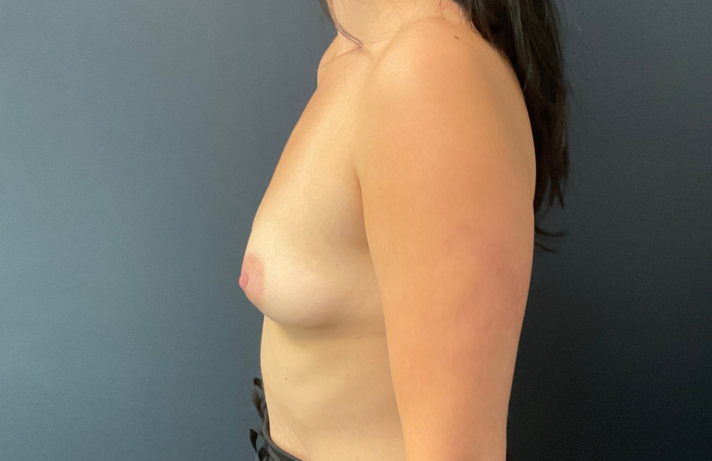 Before Image: Breast Augmentation: Mentor Smooth Moderate Plus Xtra 325cc Silicone Implants - left-side
