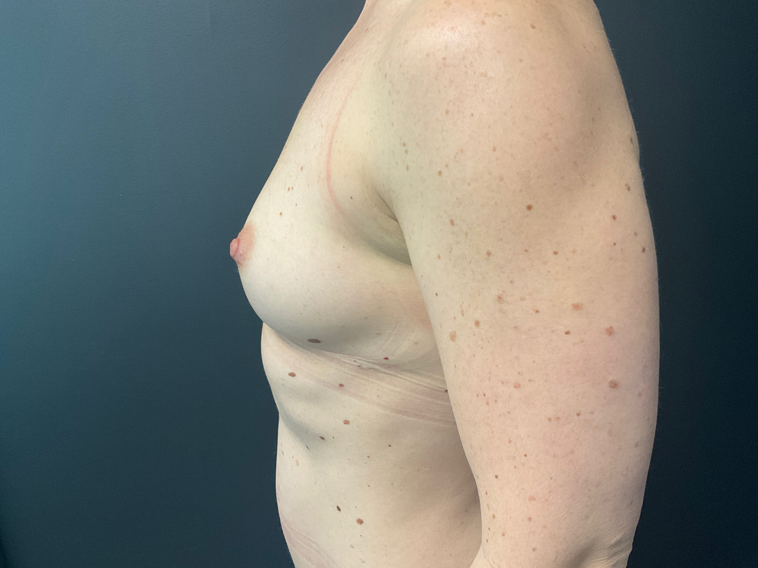 Before Image: Breast Augmentation: Mentor Smooth Round Moderate Plus 375cc Silicone Implants - left-side