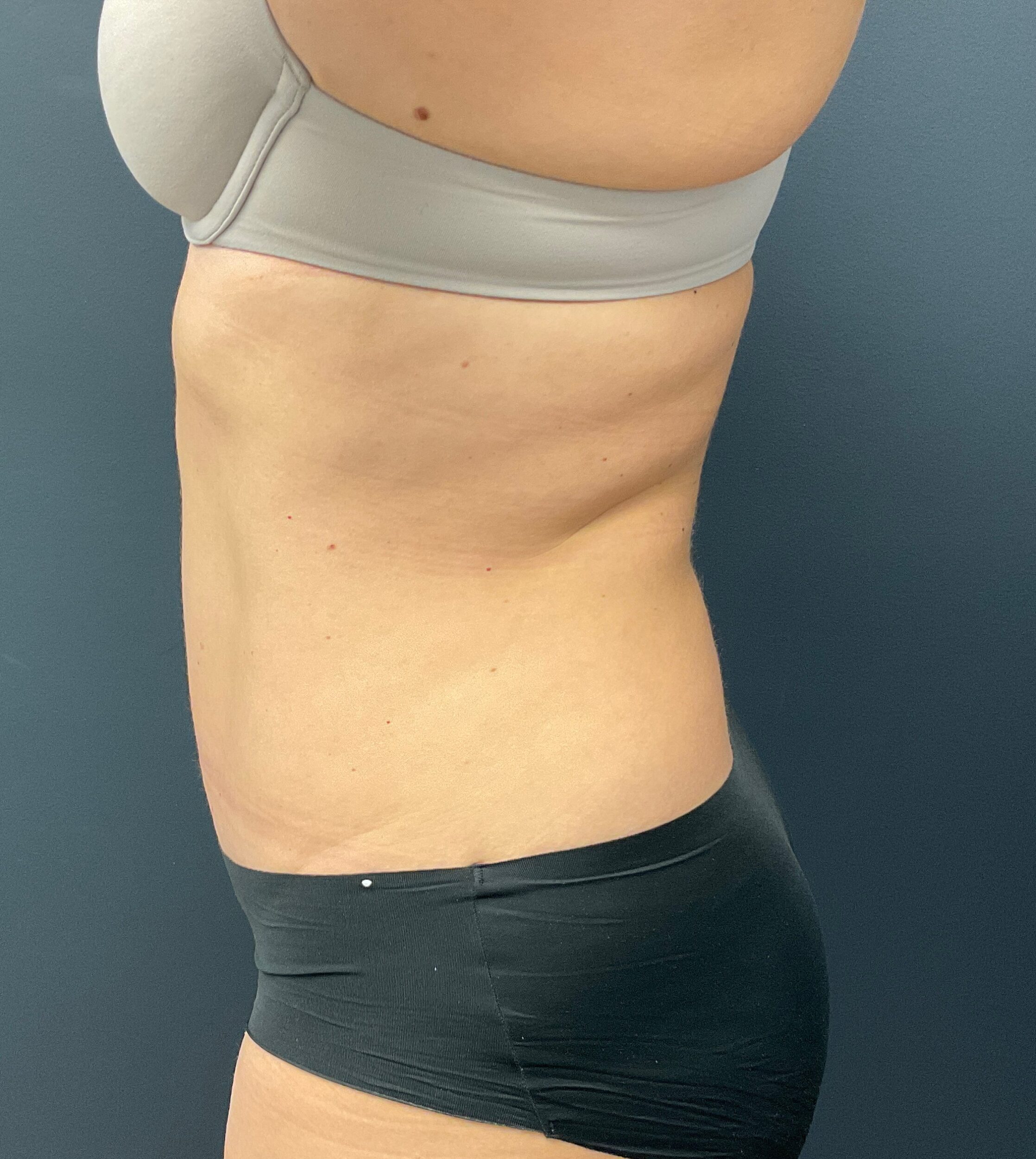 After Image: Abdominoplasty with Liposuction of Flanks - left-side