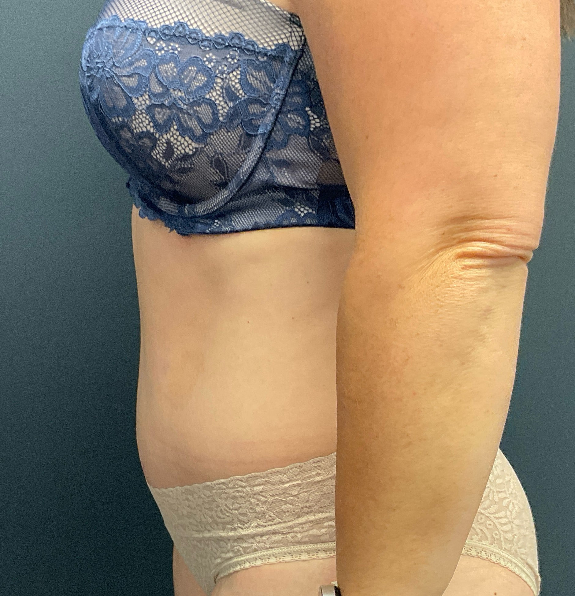 After Image: Abdominoplasty with Liposuction of Flanks - left-side