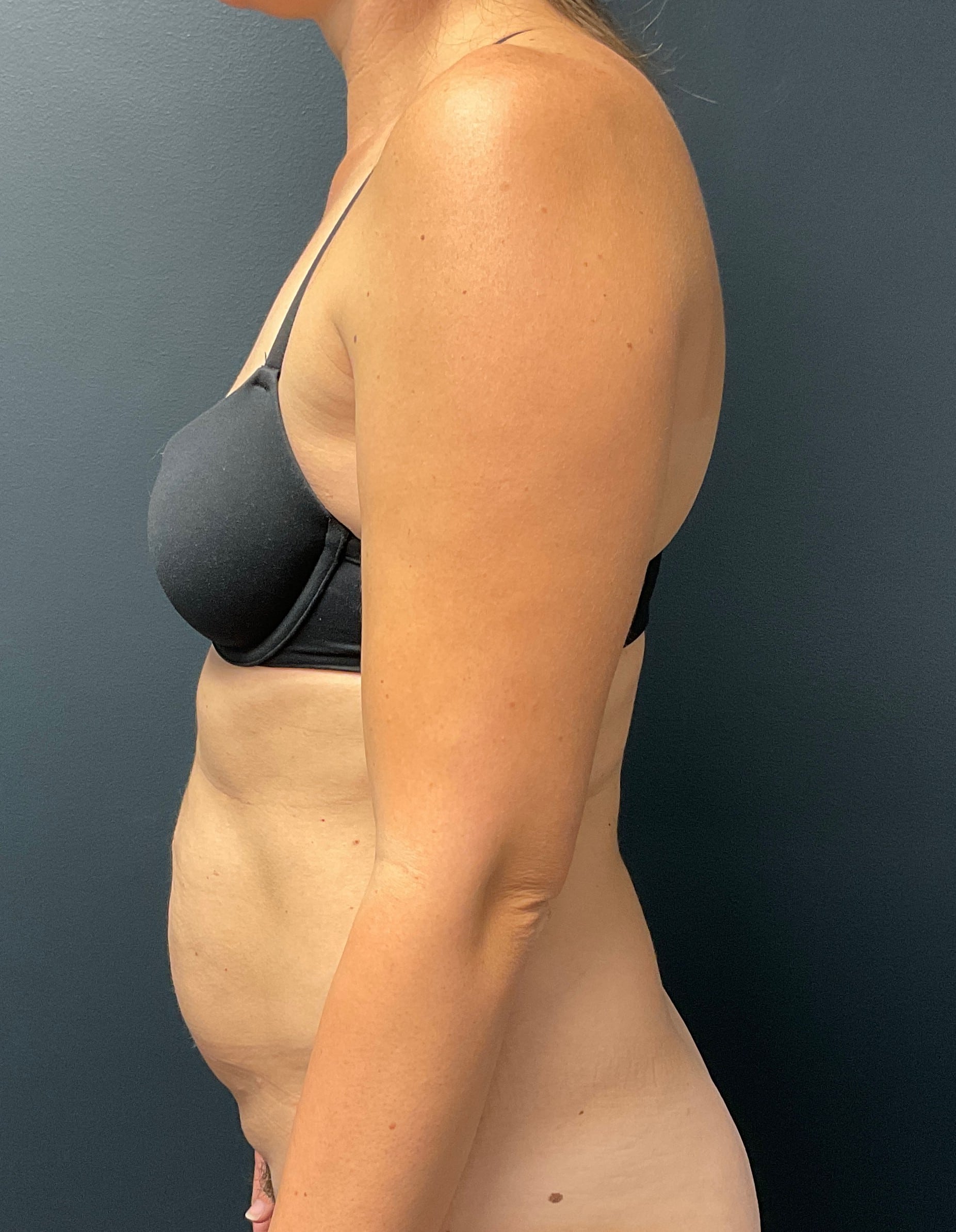 Before Image: Abdominoplasty with Liposuction of Flanks - left-side