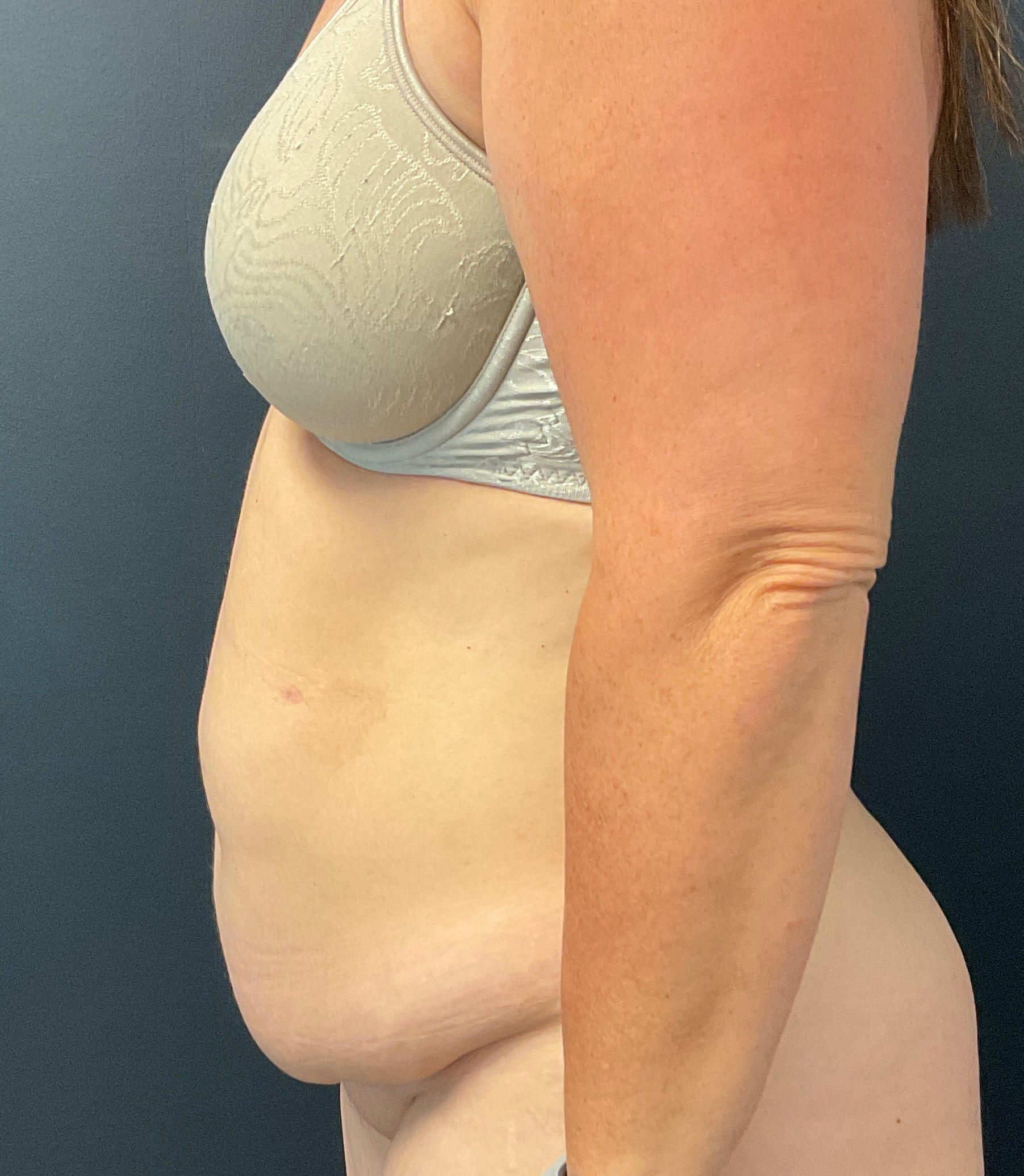 Before Image: Abdominoplasty with Liposuction of Flanks - left-side
