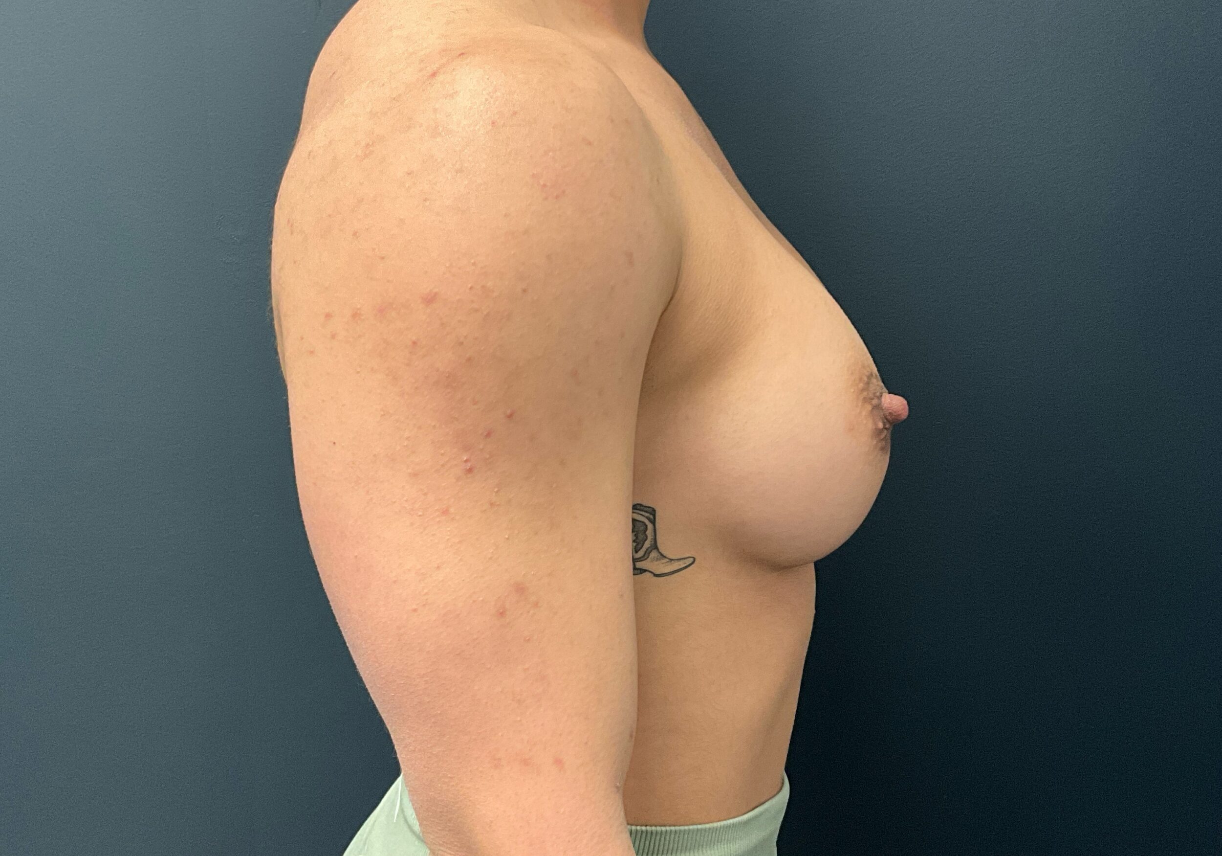 After Image: Breast Augmentation: Mentor Smooth Round Moderate Plus Silicone Implants (L) 405cc, (R) 440cc - right-side