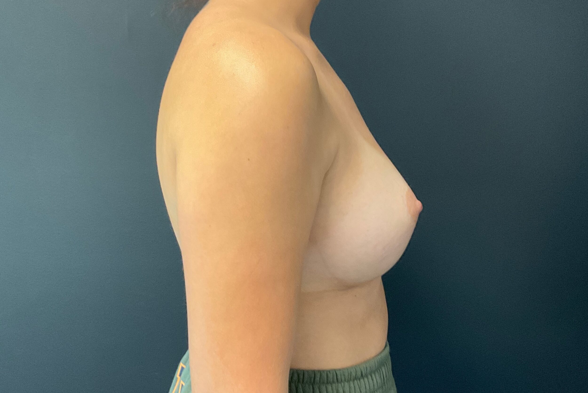 After Image: Breast Augmentation: Mentor Smooth Round Moderate Plus 325cc Silicone Implants - right-side