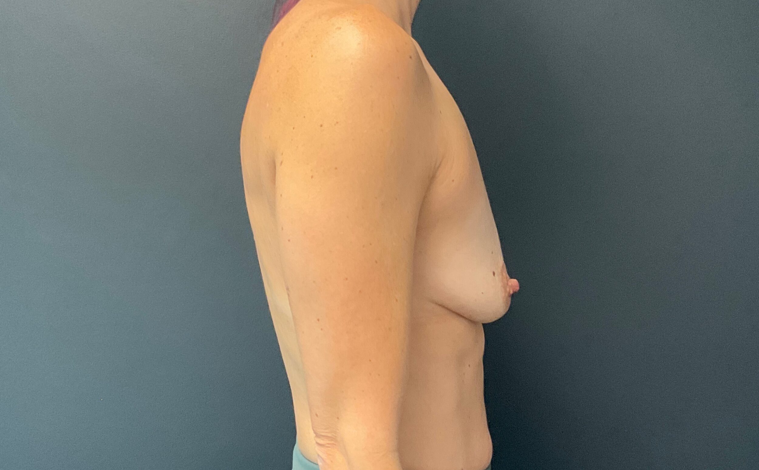 Before Image: Breast Augmentation: Mentor Smooth Round Moderate Plus 350cc Silicone Implants - right-side