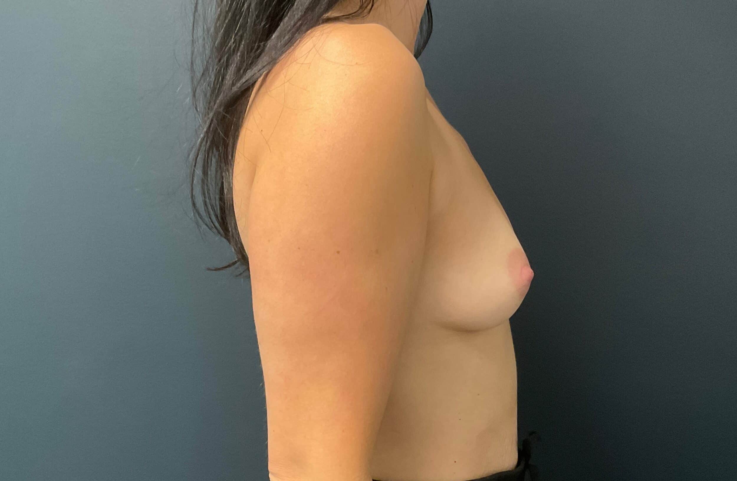 Before Image: Breast Augmentation: Mentor Smooth Moderate Plus Xtra 325cc Silicone Implants - right-side