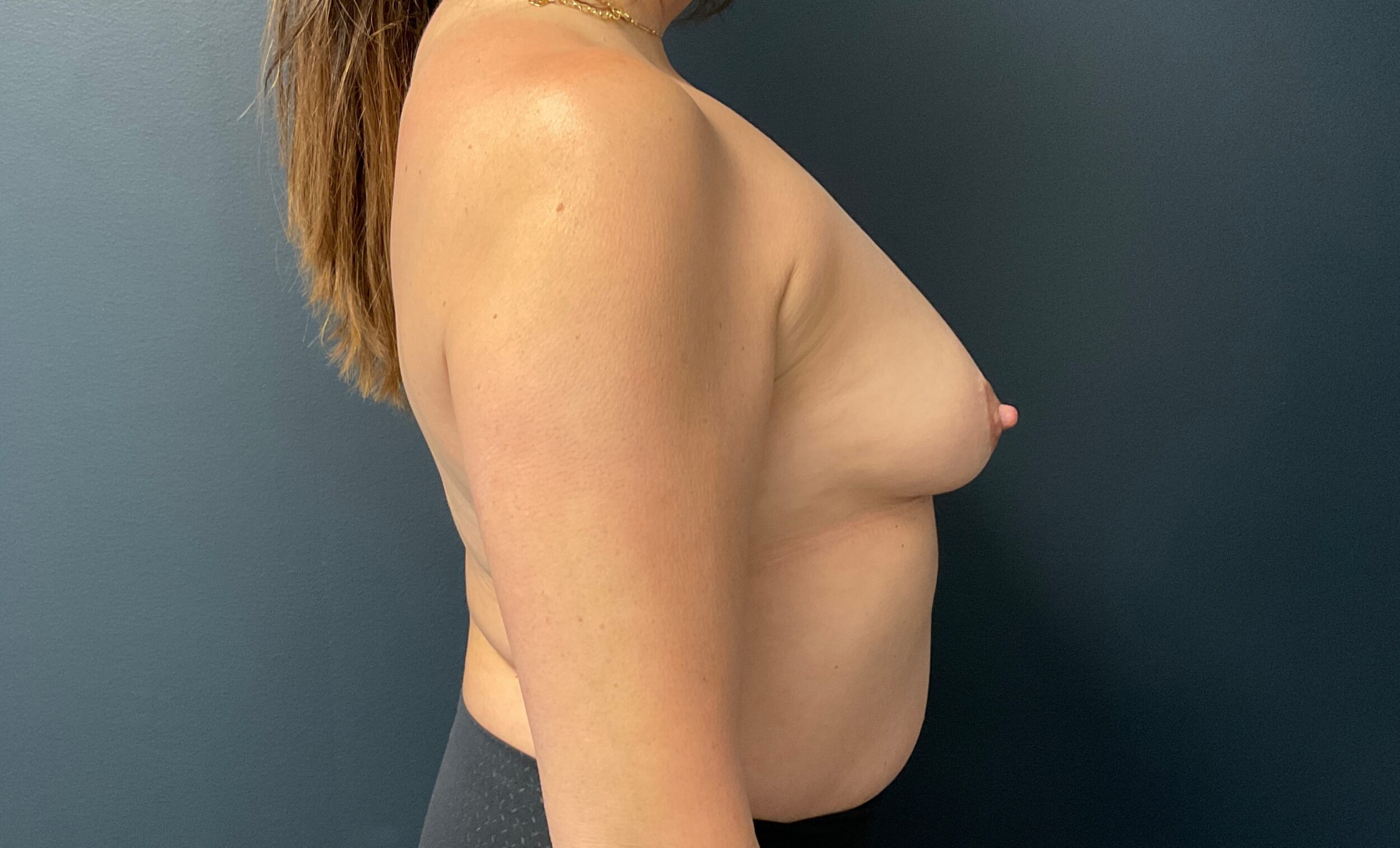 Before Image: Breast Augmentation: Mentor Smooth Round Moderate Plus 300cc Silicone Implants - right-side