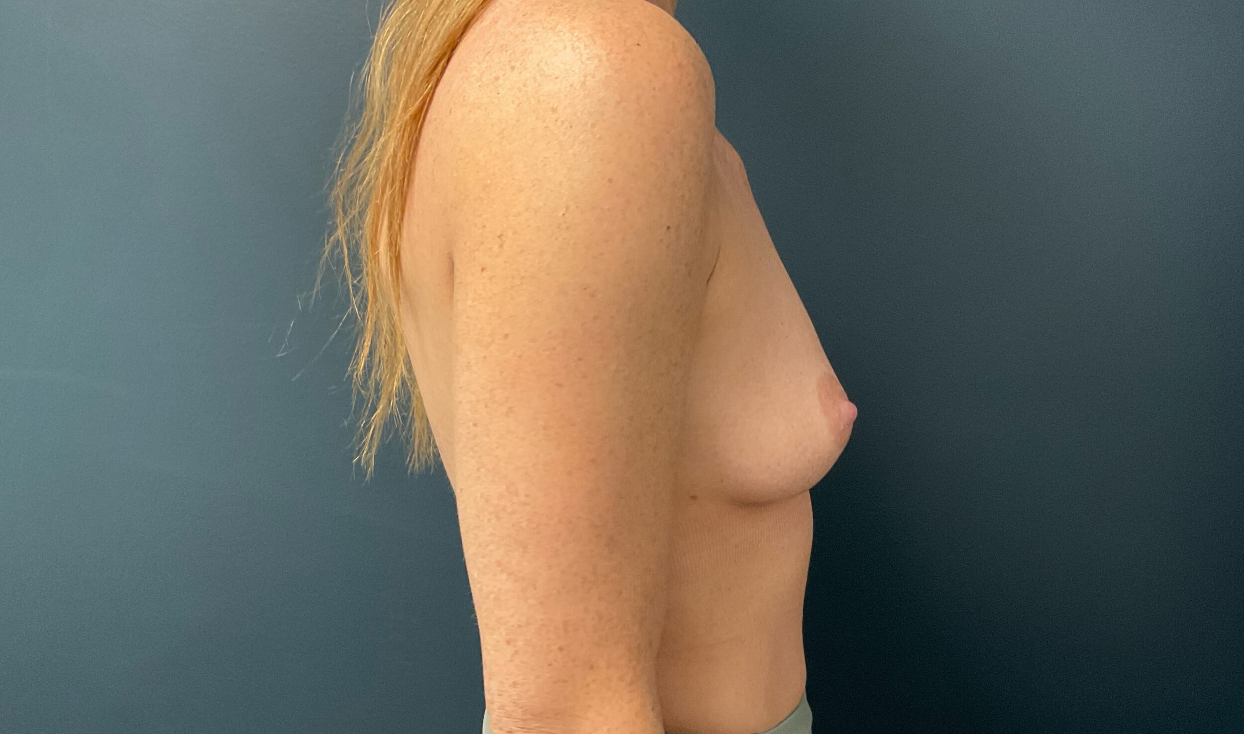 Before Image: Breast Augmentation: Mentor Smooth Round Moderate Plus 325cc Silicone Implants - right-side