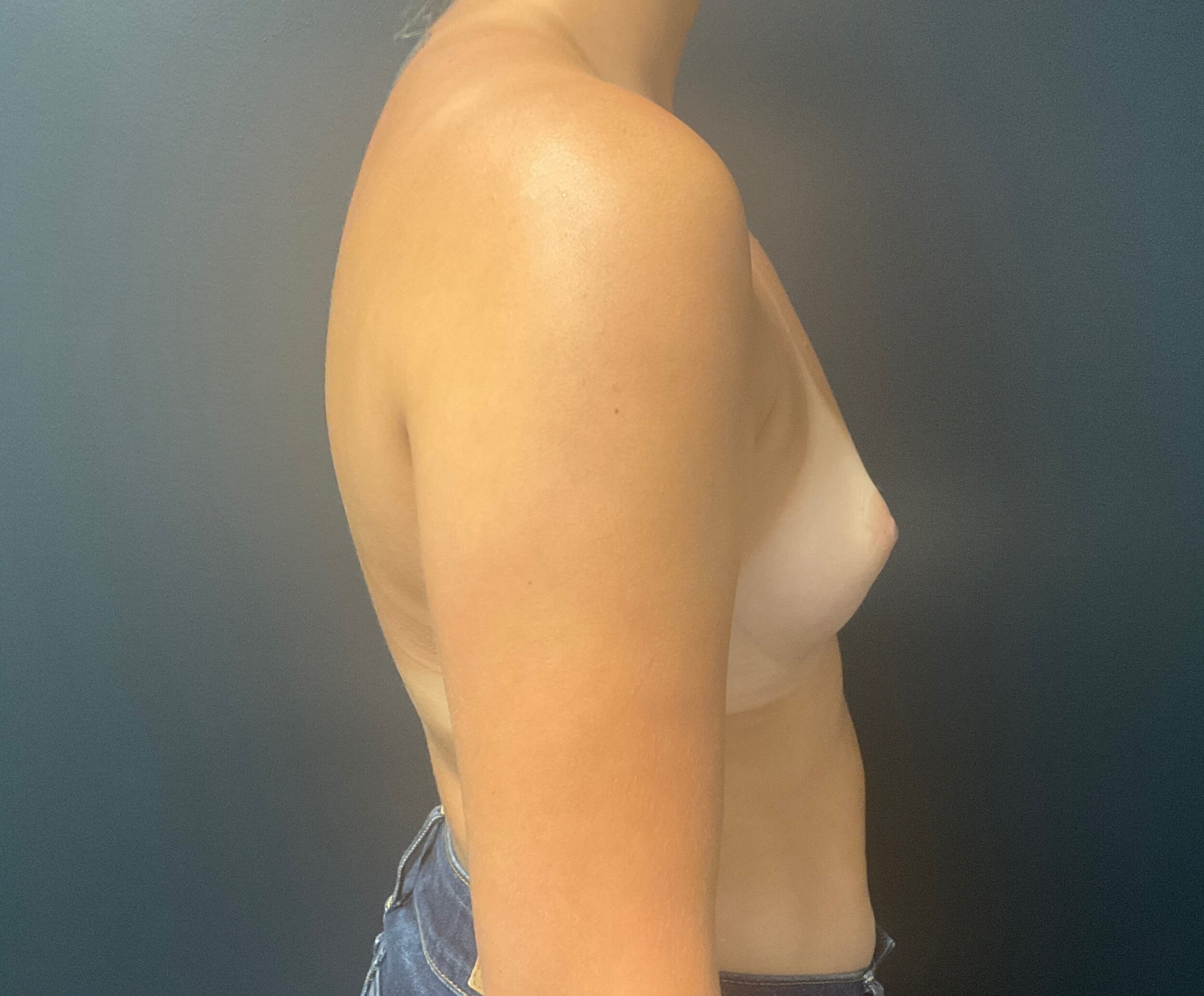 Before Image: Breast Augmentation: Mentor Smooth Round Moderate Plus 325cc Silicone Implants - right-side