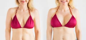 Woman,Posing,In,Bikini,Top,Before,And,After,Breast,Augmentation