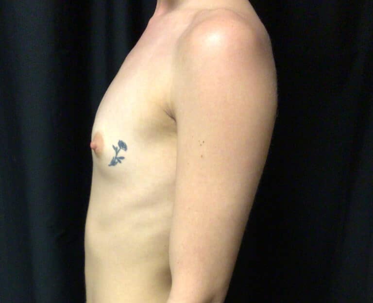 Before Image: Breast Augmentation: Mentor Smooth Round Moderate Plus 325cc Silicone Implants - left-side