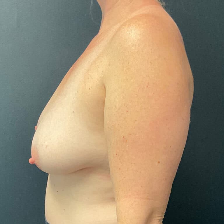 Before Image: Breast Lift and Augmentation (L 350cc R 400ccc silicone implants) - left-side