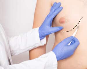 Doctor marking up male patient in breast region for male breast reduction surgery