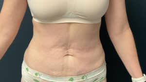 After Image: Liposuction of the Abdomen and Flanks