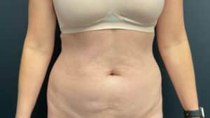 Before Image: Liposuction of the Abdomen and Flanks
