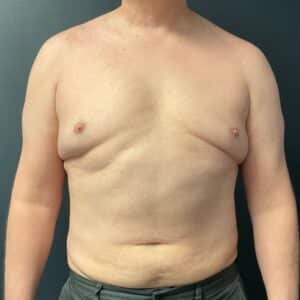 After Image: Gynecomastia (direct excision and liposuction); liposuction of abdomen and flanks