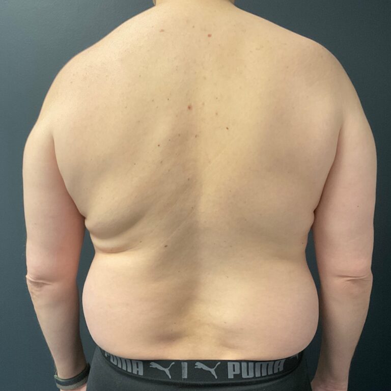 Before Image: Gynecomastia (direct excision and liposuction); liposuction of abdomen and flanks - back