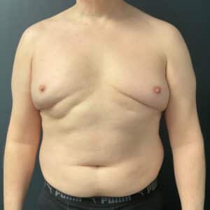 Before Image: Gynecomastia (direct excision and liposuction); liposuction of abdomen and flanks