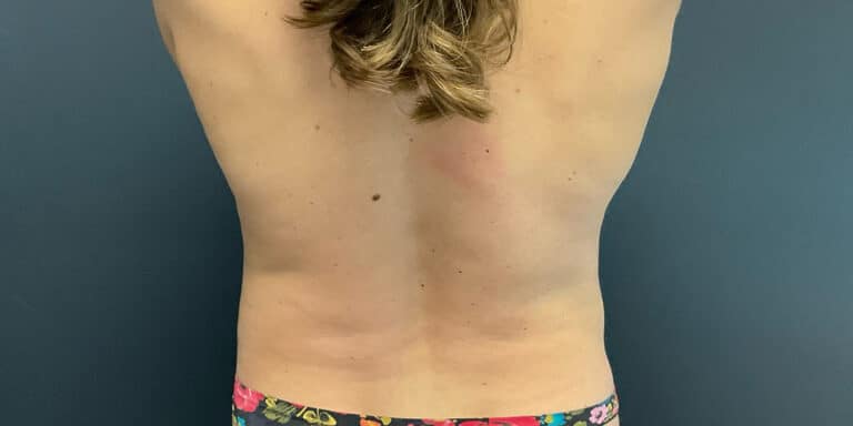 After Image: Liposuction of the Abdomen and Flanks - back