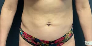 After Image: Liposuction of the Abdomen and Flanks