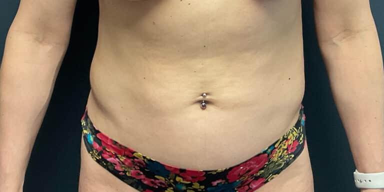 After Image: Liposuction of the Abdomen and Flanks - front