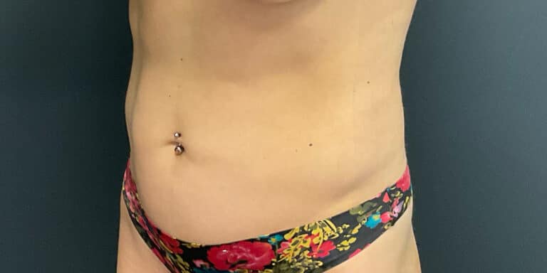 After Image: Liposuction of the Abdomen and Flanks - left-front-oblique